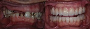teeth implant client example