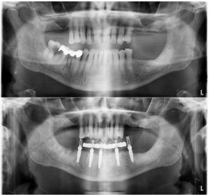 Complete tooth replacement x-rays