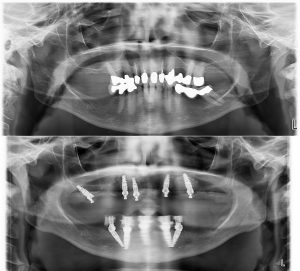 all on four implant replacement